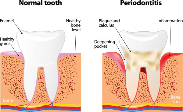 Periodontal Treatment in Lewisville