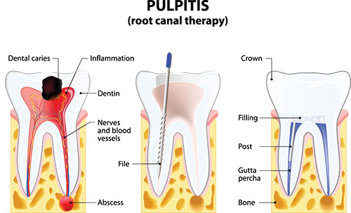 Root Canal Treatment in Lewisville