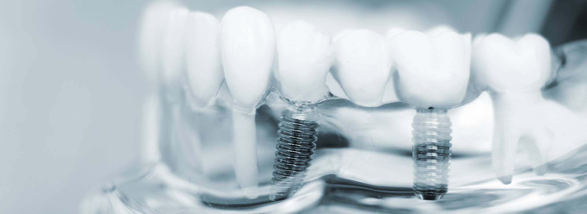 Dental Implants in Lewisville